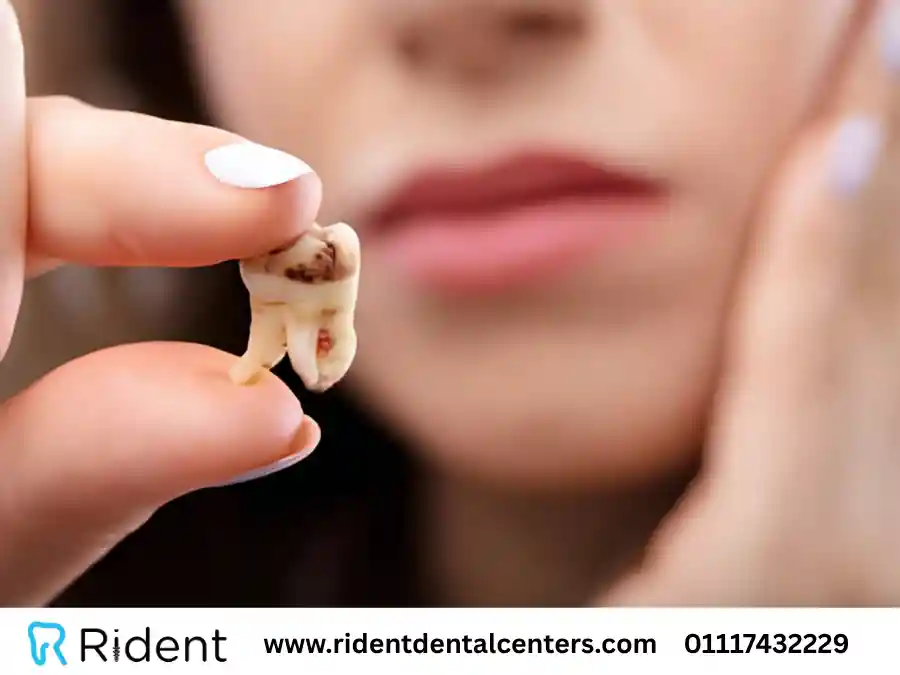 علاج تسوس الاسنان الآن نهائياً بأحدث التقنيات و6 أعراض انتبه إليها